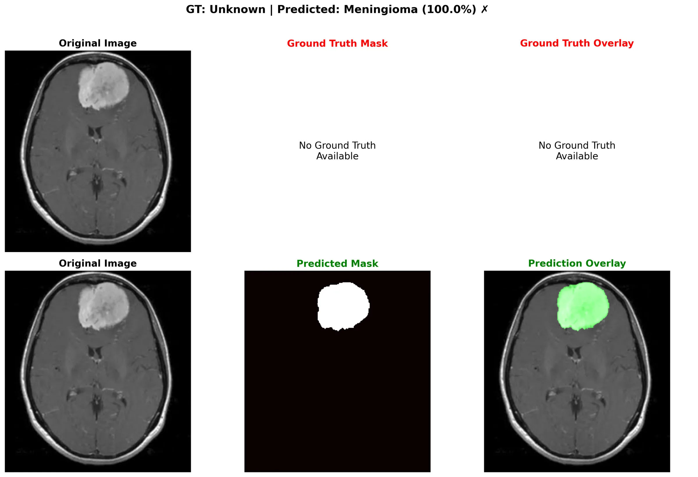 Meningioma: original, ground truth, and predicted mask