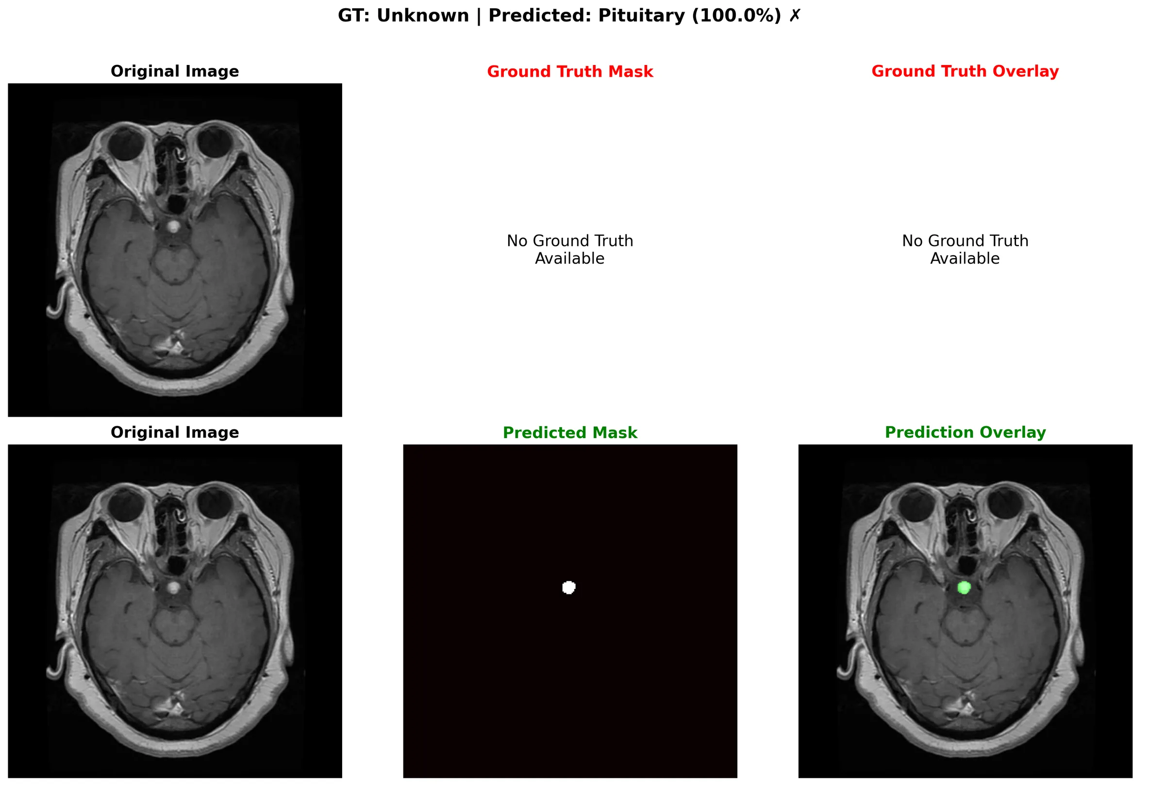 Pituitary tumor segmentation with tight boundaries
