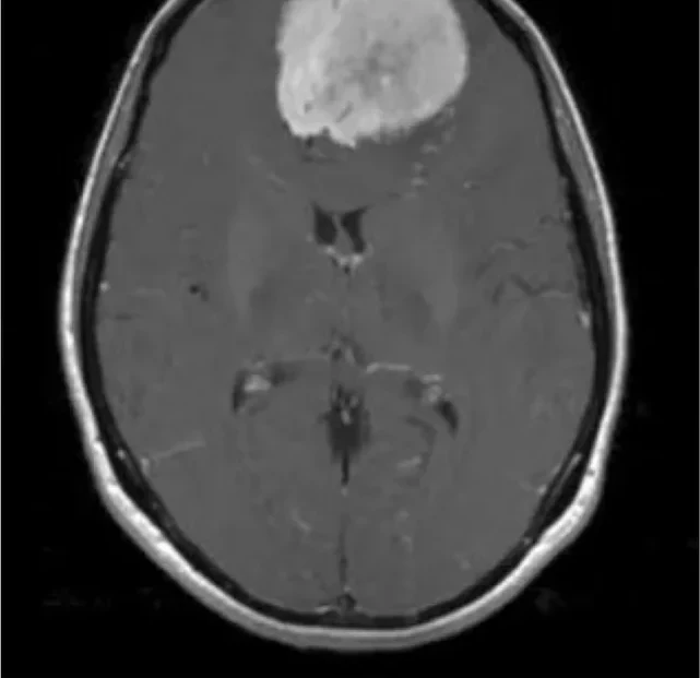 Meningioma