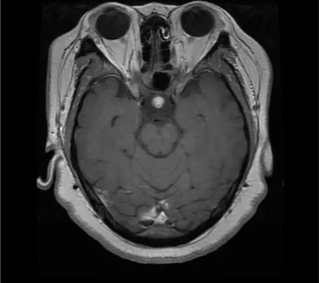 Pituitary