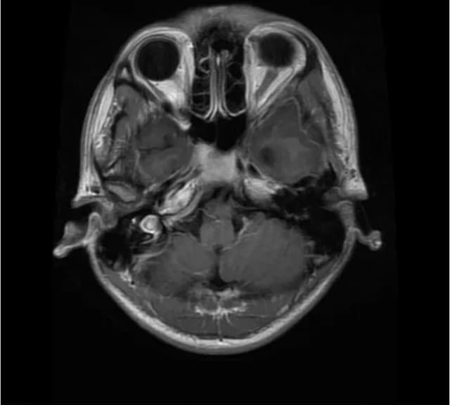 Glioma (axial)